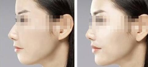 秦皇島膠原蛋白注射去法令紋價(jià)格