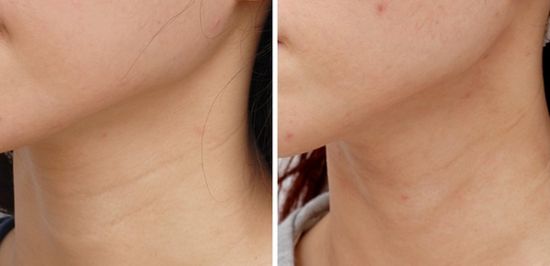 云南韓國微創(chuàng)除皺術2023價格表及相關介紹(2023云南韓國微創(chuàng)除皺術參考價為：6638元)