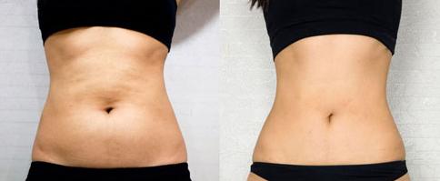 中山重瞼手術(shù)整形價(jià)格表均價(jià)公布(2023中山重瞼手術(shù)參考價(jià)為：6325元)