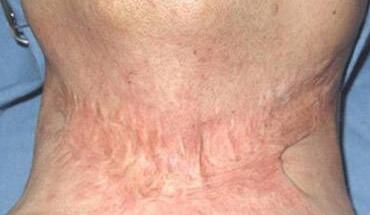 沈陽自體脂肪移植下巴費(fèi)用是多少錢一般(沈陽天橋中醫(yī)院自體脂肪移植下巴參考價(jià)：4350元)