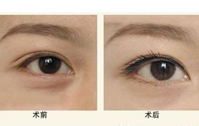 無(wú)錫杯狀耳矯正手術(shù)價(jià)格