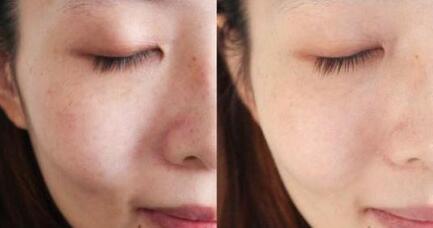 深圳電子吸脂瘦小腿價格