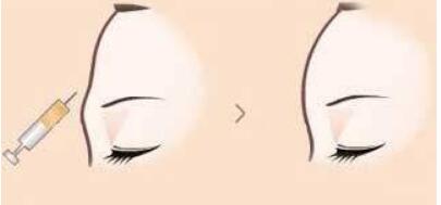 上海美雕去眼袋2023價(jià)目表全面發(fā)布(2023上海美雕去眼袋參考價(jià)為：6433元)