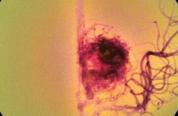 長春微骨鼻雕成形術(shù)收費標(biāo)準(zhǔn)2023明細(xì)公布(2023長春微骨鼻雕成形術(shù)參考價為：7233元)