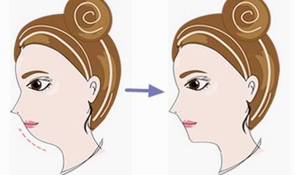 哈爾濱去凹痕點陣激光價目表均價一覽(哈爾濱索非醫(yī)療美容門診部去凹痕點陣激光參考價：4267元)