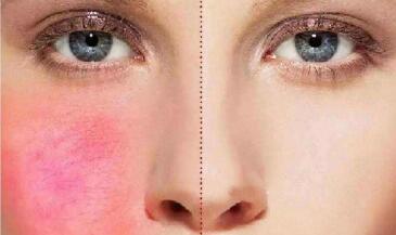 廣州手術(shù)切除生長紋一般要手術(shù)多少錢(2023廣州手術(shù)切除生長紋參考價為：6767元)