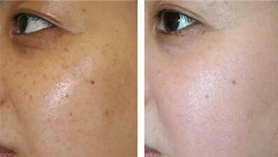 長(zhǎng)沙彩光嫩膚去黃褐斑一次大概要花多少錢(2023長(zhǎng)沙彩光嫩膚去黃褐斑參考價(jià)為：6607元)