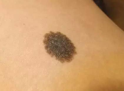 武漢C10祛斑治療價位表預(yù)覽(2023武漢C10祛斑參考價為：5769元)