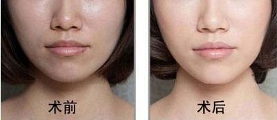 濟(jì)寧手術(shù)去動(dòng)態(tài)細(xì)紋整形價(jià)格信息預(yù)覽(2023濟(jì)寧手術(shù)去動(dòng)態(tài)細(xì)紋參考價(jià)為：6492元)