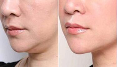 無(wú)錫無(wú)創(chuàng)激光溶脂的手術(shù)費(fèi)用需要多少錢合適(2023無(wú)錫無(wú)創(chuàng)激光溶脂參考價(jià)為：6710元)