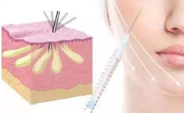 北京去皺紋法令紋價目表全新來襲(2023北京去皺紋法令紋參考價為：4361元)