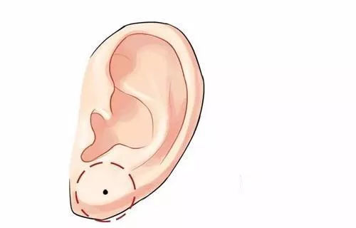 懷化玻尿酸注射法填充痤瘡瘢痕一次應該需要多少費用(懷化美蒂珂醫(yī)療美容玻尿酸注射法填充痤瘡瘢痕參考價：5646元)