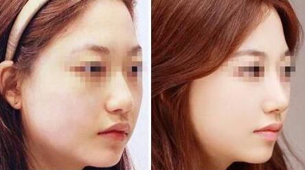 新鄉(xiāng)打針去眼底紋手術(shù)價(jià)錢一覽表上線(2023新鄉(xiāng)打針去眼底紋參考價(jià)為：7175元)