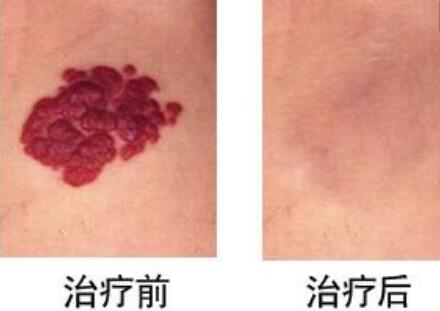 武漢超聲炮溶脂價格