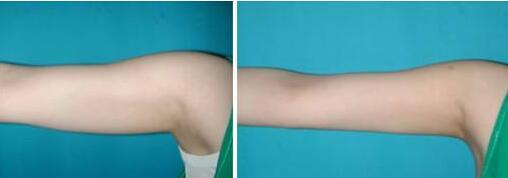 北京手術(shù)消除肥胖紋整形價格全面發(fā)布(2023北京手術(shù)消除肥胖紋參考價為：6098元)