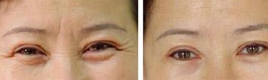 浙江筒狀乳房畸形矯正的價格需要多少錢合適(2023浙江筒狀乳房畸形矯正參考價為：6081元)