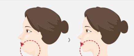 西安玻尿酸填充術(shù)的價(jià)位全新公開(2023西安玻尿酸填充術(shù)參考價(jià)為：6623元)