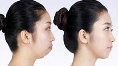 太原自體脂肪填充下巴曲線價(jià)位表明細(xì)清單一覽(2023太原自體脂肪填充下巴曲線參考價(jià)為：6776元)