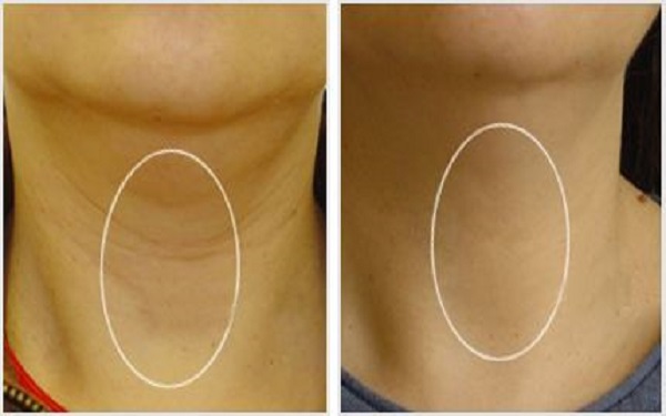 深圳激光美容除皺報價價錢多少錢(2023深圳激光美容除皺參考價為：6769元)