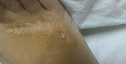 昆明皮膚磨削祛疤價(jià)格表2023公布(2023昆明皮膚磨削祛疤參考價(jià)為：6426元)