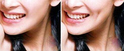 佛山激光祛除魚尾紋價(jià)格表價(jià)位明細(xì)一覽(2023佛山激光祛除魚尾紋參考價(jià)為：6679元)