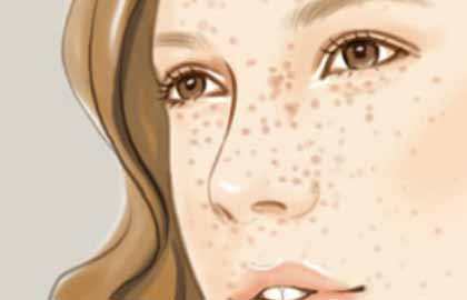 杭州玻尿酸注射去皺大概需要治療費(fèi)用是多少(杭州壹西光合醫(yī)療美容診所玻尿酸注射去皺參考價(jià)：5757元)