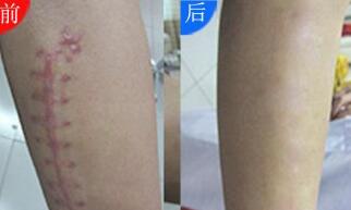 昆明熱瑪吉祛疤痕費(fèi)用明細(xì)更新(2023昆明熱瑪吉祛疤痕參考價為：5976元)