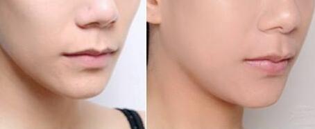 北京美雕去川字紋整形優(yōu)惠價格表明細(xì)參考(2023北京美雕去川字紋參考價為：5830元)