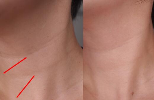 四川瘦腿吸脂肪價(jià)目表標(biāo)準(zhǔn)更新(2023四川瘦腿吸脂肪參考價(jià)為：6510元)