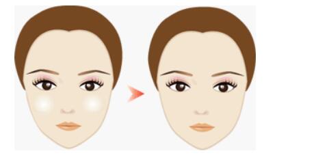 ?？谟〉诎布y去除治療價目表收費標(biāo)準(zhǔn)公開(2023?？谟〉诎布y去除參考價為：6567元)