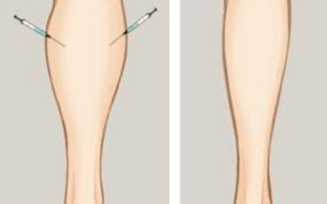 上海注射去妊娠紋2023價格表新版出爐(2023上海注射去妊娠紋參考價為：5974元)