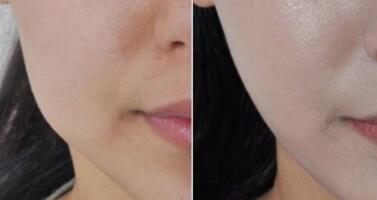 廣州微雕去除法令紋價(jià)格