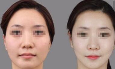 ?？谖⒕ハ髦委熑赴哒蝺r(jià)位表查看(2023海口微晶磨削治療雀斑參考價(jià)為：6284元)