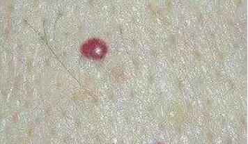 濟(jì)南內(nèi)窺鏡除皺祛魚尾紋價(jià)格