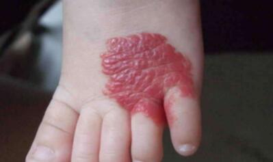 金華去除雀斑皮秒祛斑治療價目表明細公開(金華婦幼保健院整形科去除雀斑皮秒祛斑參考價：5429元)