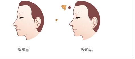 成都川字紋填充自體脂肪價(jià)格