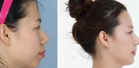 杭州骨雕鼻子2023價格明細表全新上線(杭州東方整形美容門診部骨雕鼻子參考價：4094元)