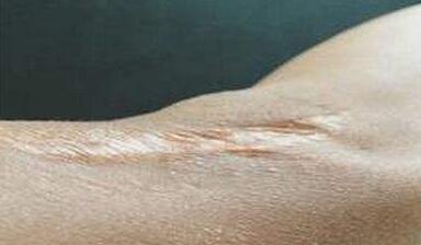 邯鄲鐳射激光祛眼周細紋手術費用公布(邯鄲佑熙醫(yī)療美容門診部鐳射激光祛眼周細紋參考價：6740元)