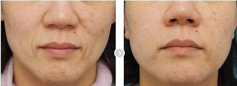 合肥膠原蛋白去肥胖紋費用2023強勢來襲(2023合肥膠原蛋白去肥胖紋參考價為：6351元)