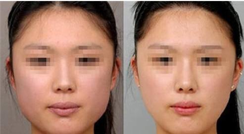 阜陽(yáng)面部除疤痕收費(fèi)標(biāo)準(zhǔn)全新公布(2023阜陽(yáng)面部除疤痕參考價(jià)為：6352元)