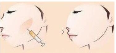 泉州注射肉毒素去動態(tài)紋手術(shù)價格信息查詢(2023泉州注射肉毒素去動態(tài)紋參考價為：6023元)