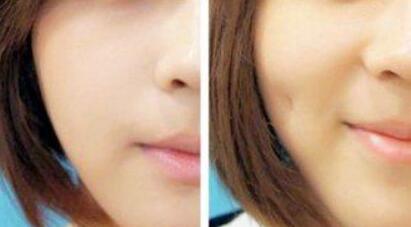 北京皮膚松弛下垂緊致治療價(jià)格清單查詢(2023北京皮膚松弛下垂緊致參考價(jià)為：5858元)