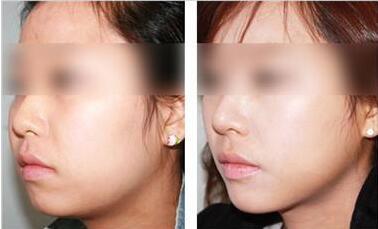 上海結(jié)扎整形酒窩整形價(jià)目表清單預(yù)覽(2023上海結(jié)扎整形酒窩參考價(jià)為：5581元)