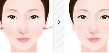 貴州射頻微針祛細(xì)紋手術(shù)費(fèi)用曝光(2023貴州射頻微針祛細(xì)紋參考價(jià)為：6362元)