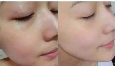 四川皮秒激光去除色素手術費查詢(2023四川皮秒激光去除色素參考價為：6905元)