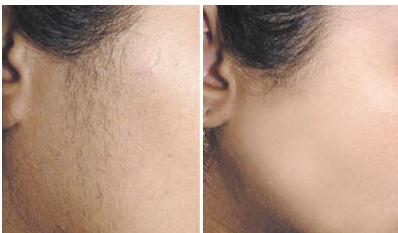 日照注射去除頸紋治療價格明細公開(2023日照注射去除頸紋參考價為：6828元)