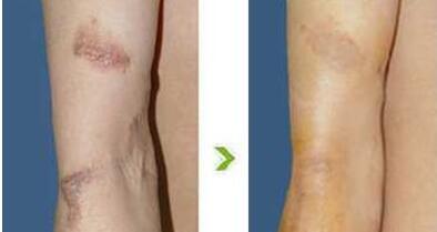 寧波吸脂溶脂大概費用一覽表(2023寧波吸脂溶脂參考價為：7133元)