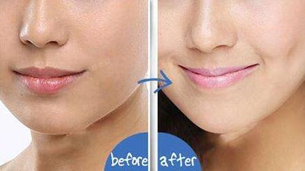 深圳玻尿酸注射木偶紋2023價(jià)格表價(jià)位表(2023深圳玻尿酸注射木偶紋參考價(jià)為：7516元)