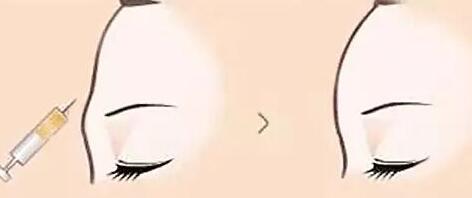 昆明膠原蛋白填充豐臀部收費(fèi)明細(xì)介紹(2023昆明膠原蛋白填充豐臀部參考價(jià)為：6060元)