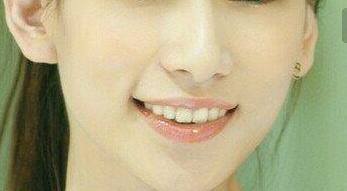 浙江痘印痘坑治療整形價位剖析(2023浙江痘印痘坑治療參考價為：7020元)